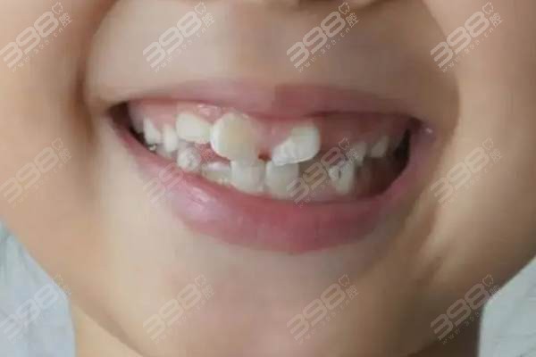 家长担心：小孩新换的恒牙长歪了怎么办？后期能够自动归位吗
