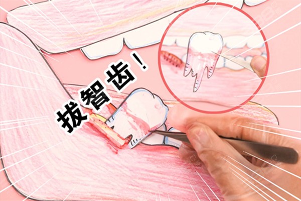 上海皓星口腔拔智齿多少钱？