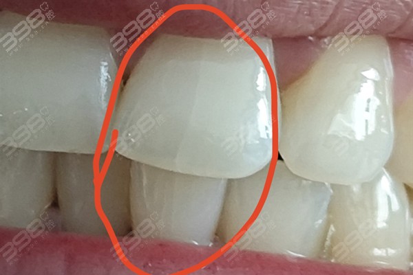 门牙有裂纹还能撑几年？怎么处理比较好？分享从轻度到重度的处理指南